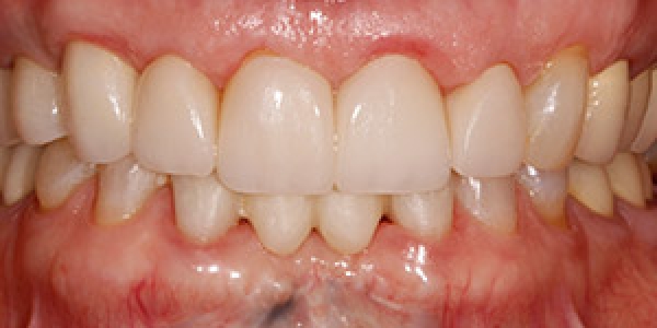 After image
