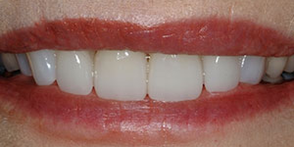 After image