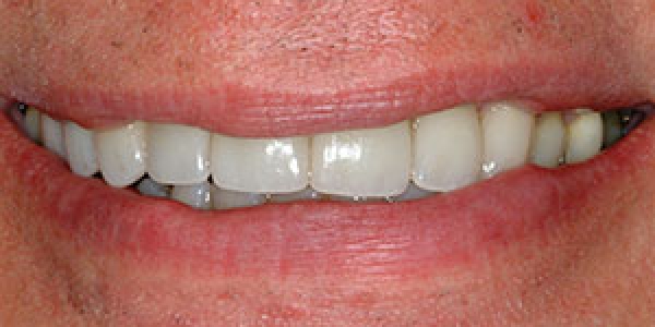 After image